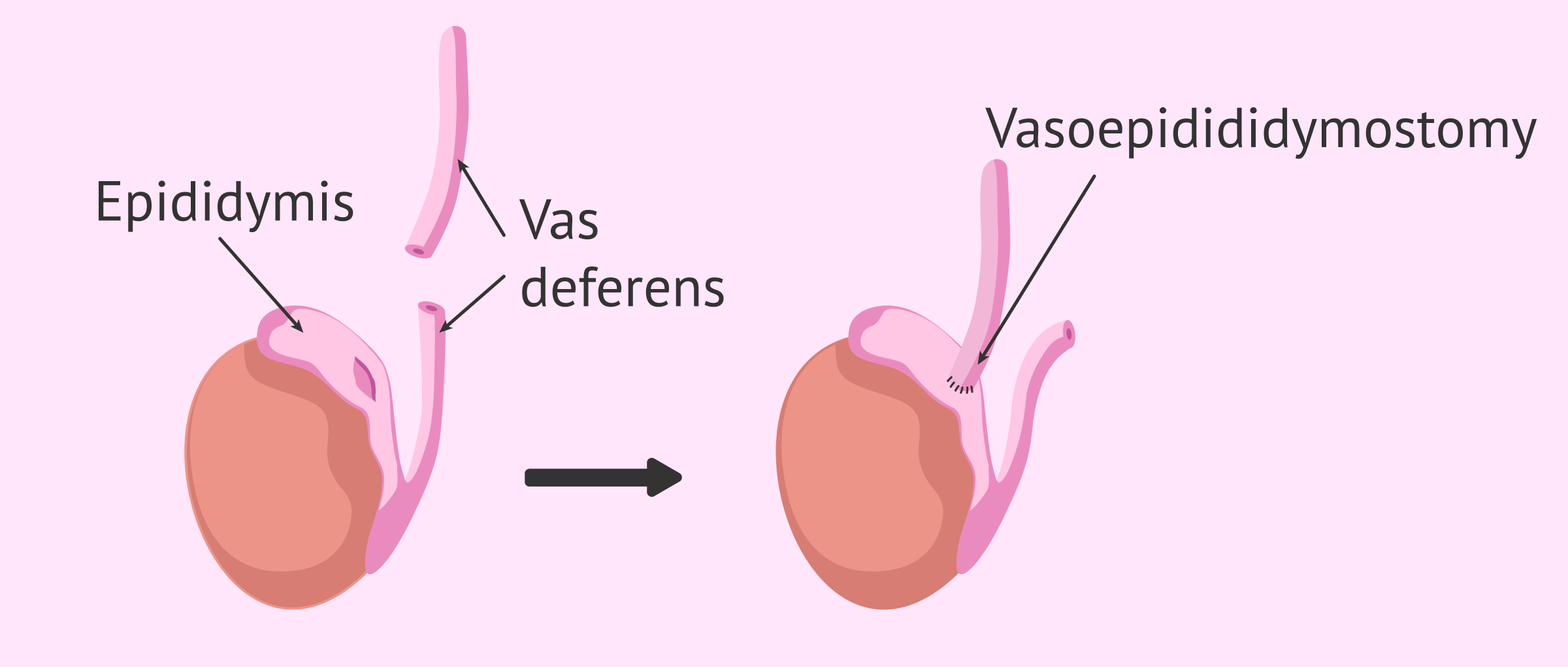 Vasoepididymostomy